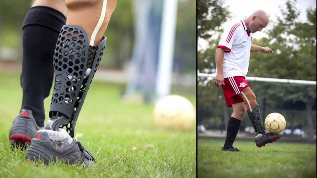 3d printed prosthetic